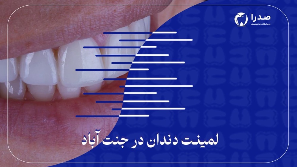 لمینت دندان در جنتآباد لمینت دندان در جنتآباد