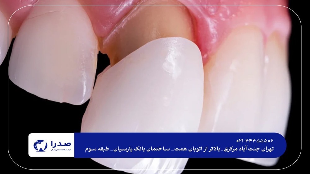 لمینت دندان در جنتآباد لمینت دندان در جنتآباد