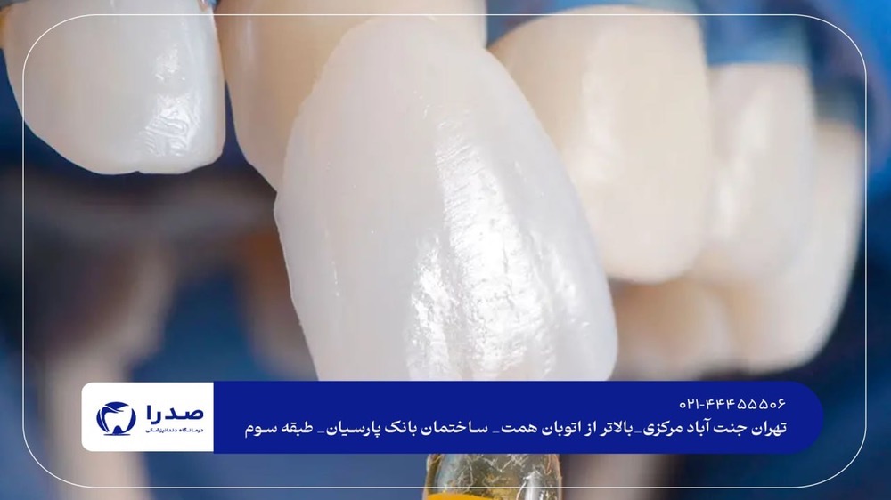لمینت دندان در جنتآباد لمینت دندان در جنتآباد