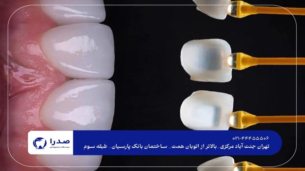 لمینت دندان در جنتآباد لمینت دندان در جنتآباد