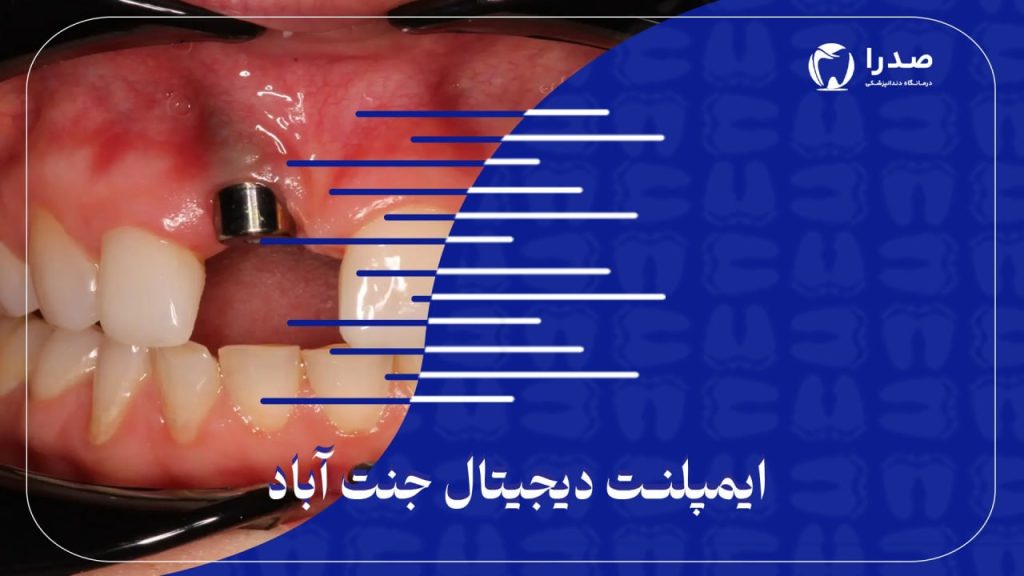 ایمپلنت دیجیتال جنت آباد