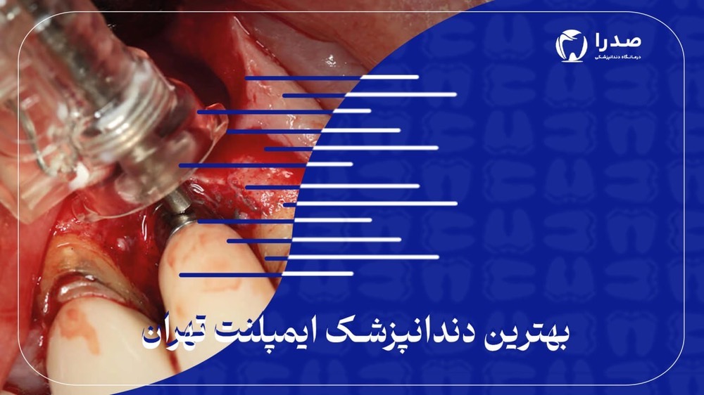 بهترین دندانپزشک ایمپلنت تهران بهترین دندانپزشک ایمپلنت تهران
