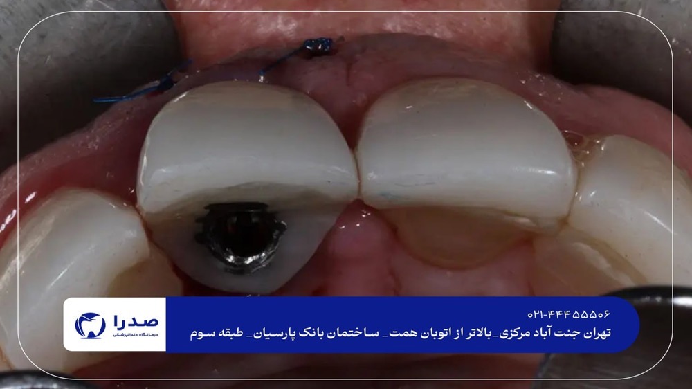 بهترین دندانپزشک ایمپلنت تهران بهترین دندانپزشک ایمپلنت تهران