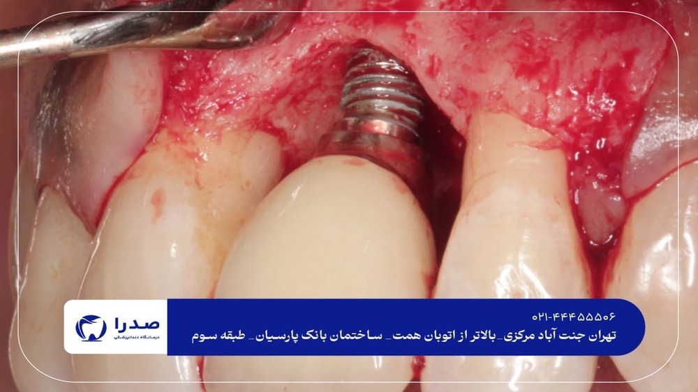 بهترین دندانپزشک ایمپلنت تهران بهترین دندانپزشک ایمپلنت تهران