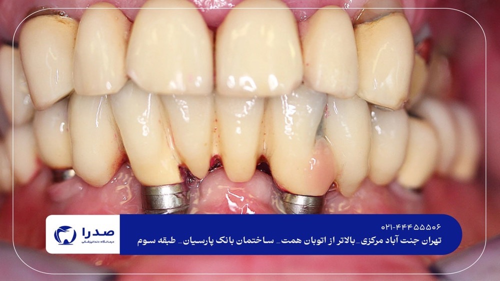 بهترین دندانپزشک ایمپلنت تهران بهترین دندانپزشک ایمپلنت تهران
