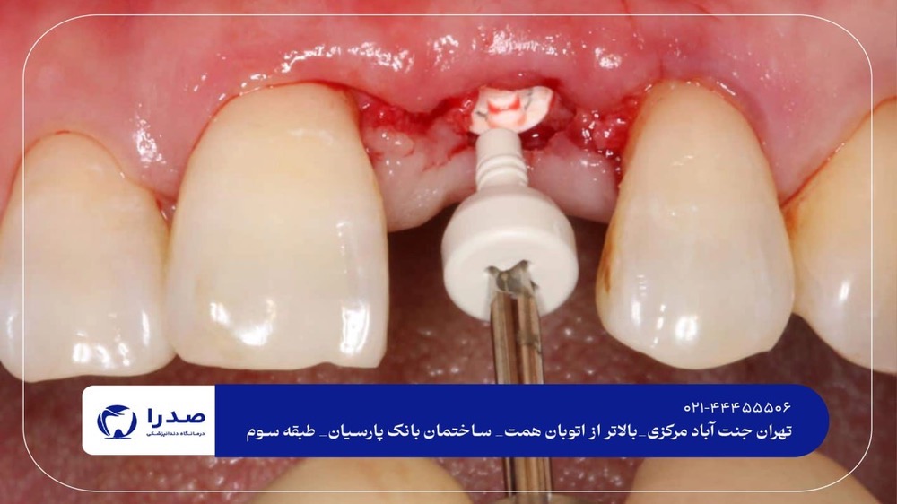 بهترین راه کاشت دندان بهترین راه کاشت دندان