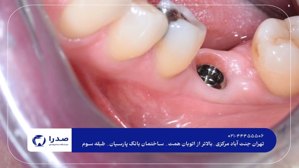 بهترین راه کاشت دندان بهترین راه کاشت دندان