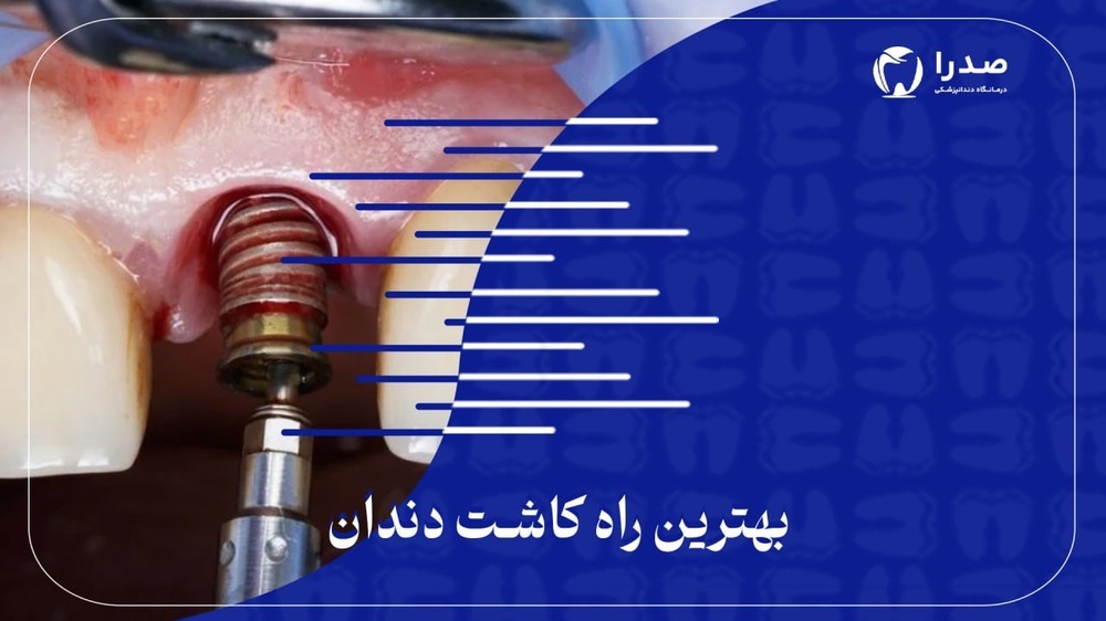 بهترین راه کاشت دندان بهترین راه کاشت دندان