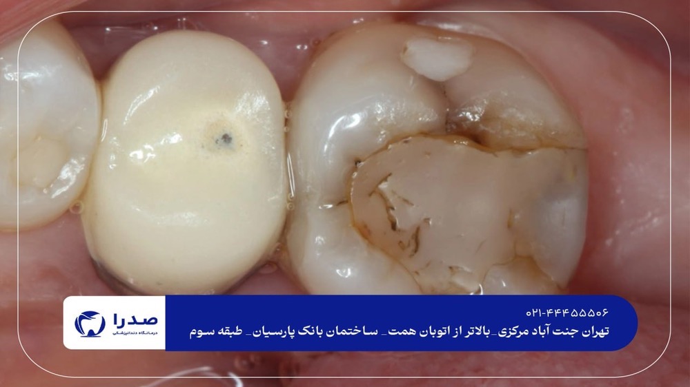 ترمیم دندان در جنت آباد ترمیم دندان در جنت آباد