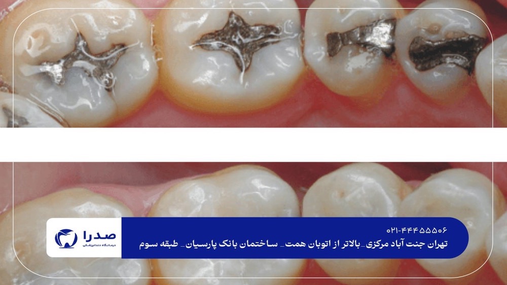 ترمیم دندان در جنت آباد ترمیم دندان در جنت آباد
