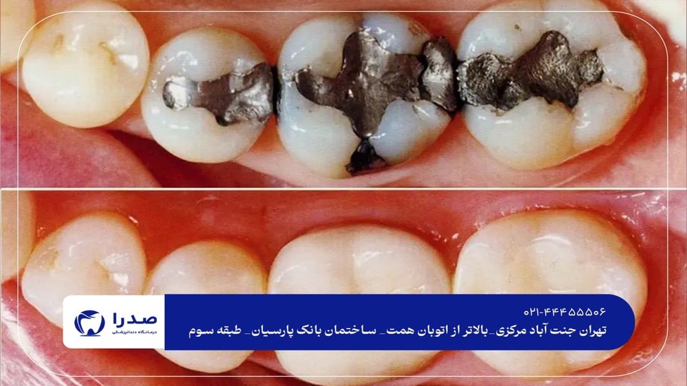 ترمیم دندان در جنت آباد ترمیم دندان در جنت آباد