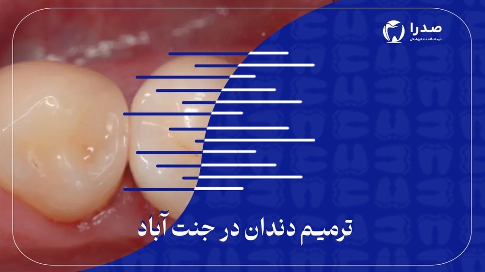 ترمیم دندان در جنت آباد ترمیم دندان در جنت آباد