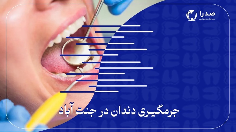 جرم گیری دندان در جنت آباد جرم گیری دندان در جنت آباد