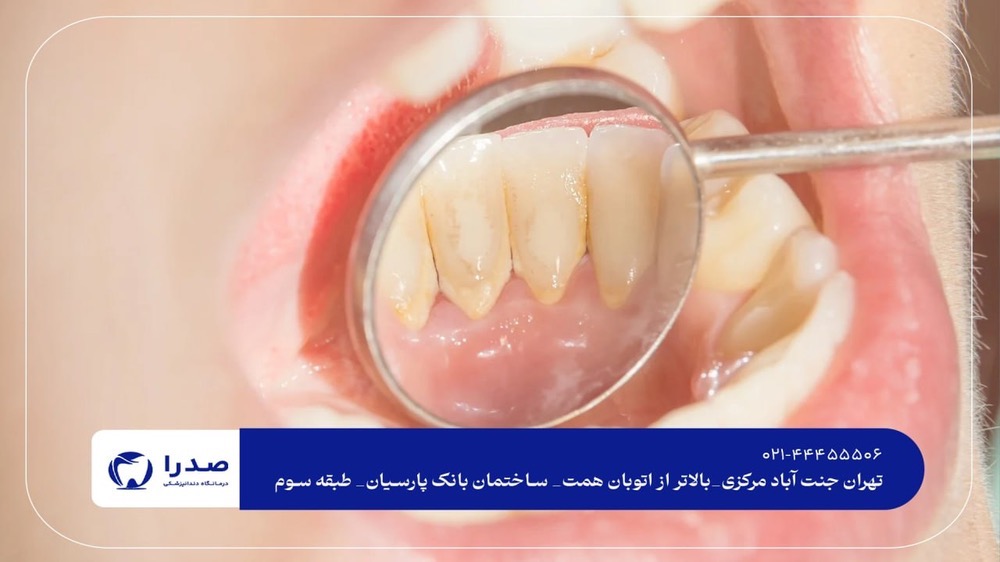 جرم گیری دندان در جنت آباد جرم گیری دندان در جنت آباد