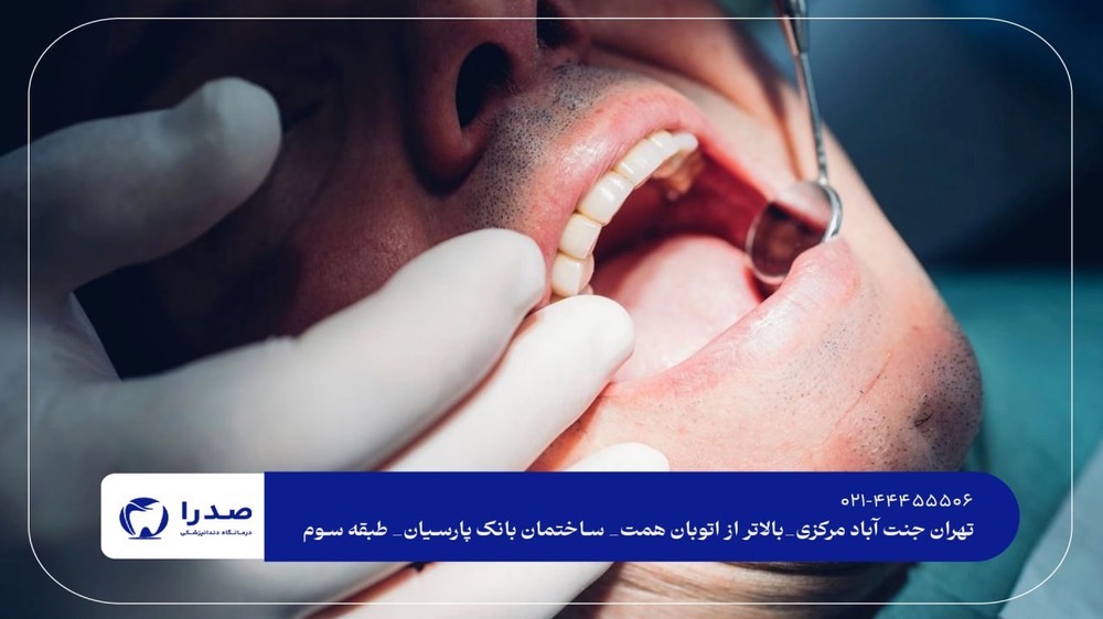 جرم گیری دندان در جنت آباد جرم گیری دندان در جنت آباد