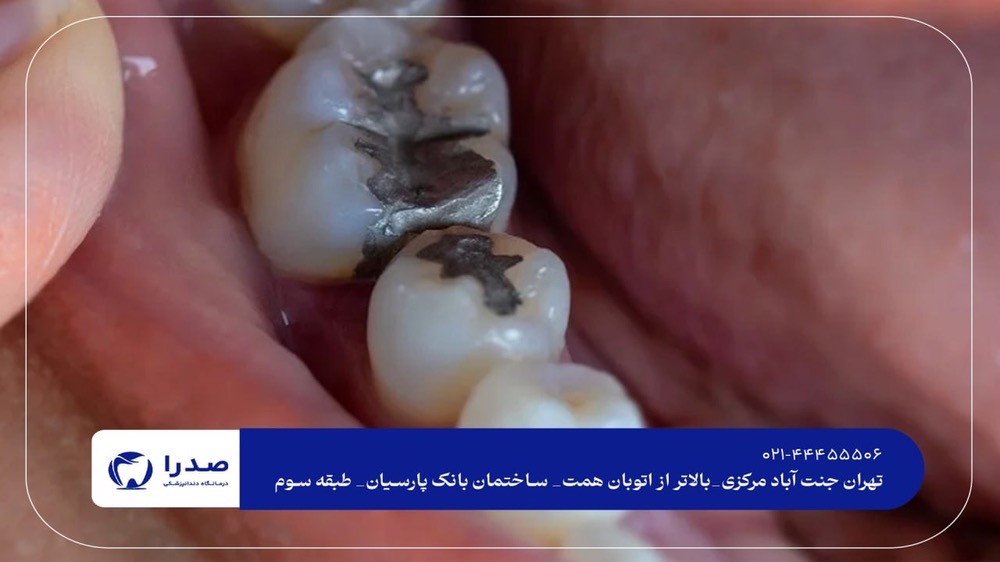 عصب کشی و پرکردن دندان در غرب تهران عصب کشی و پرکردن دندان در غرب تهران