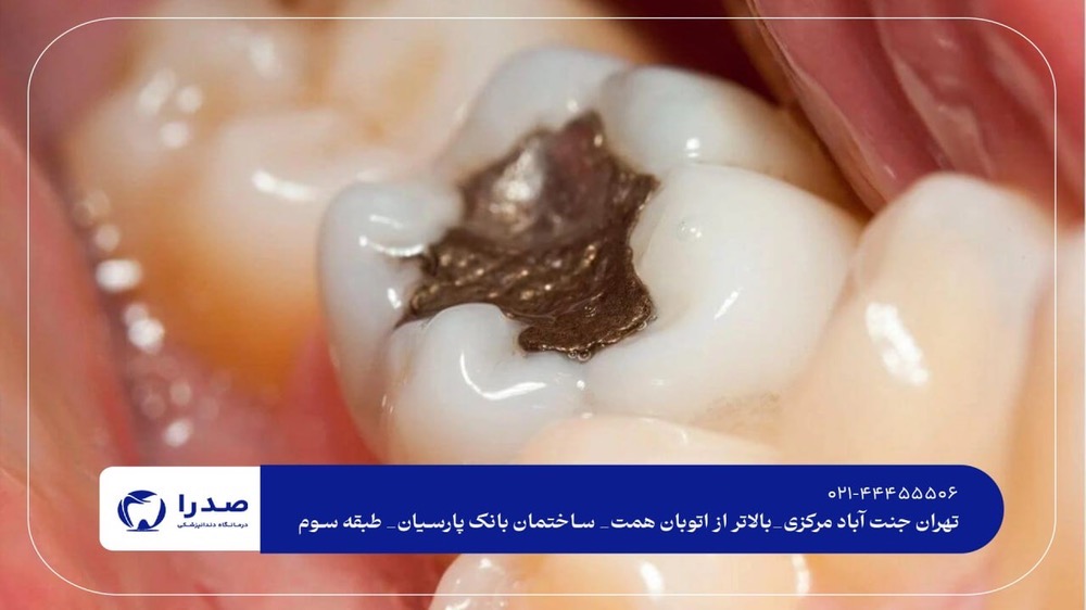 عصب کشی و پرکردن دندان در غرب تهران عصب کشی و پرکردن دندان در غرب تهرانعصب کشی و پرکردن دندان در غرب تهران