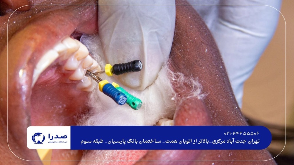 عصب کشی و پرکردن دندان در غرب تهران عصب کشی و پرکردن دندان در غرب تهران