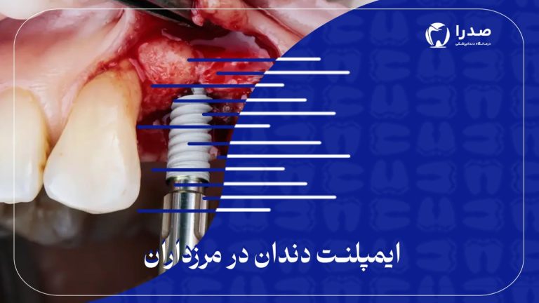ایمپلنت دندان در مرزداران