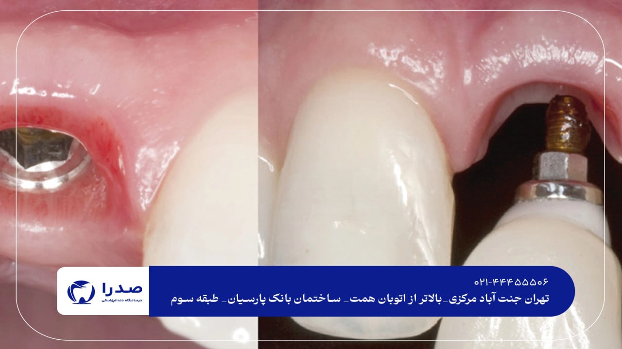ایمپلنت دیجیتال در کلینیک صدرا