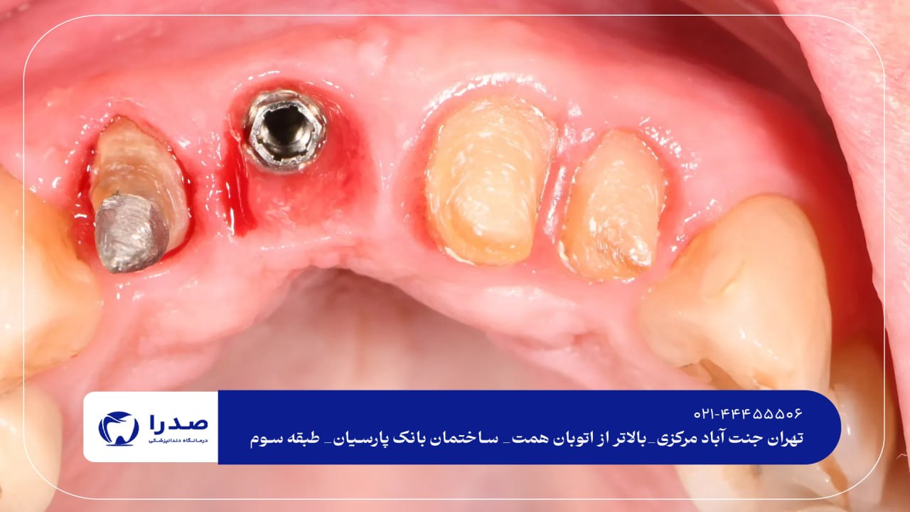 ایمپلنت دندان در تهران ایمپلنت دندان در تهران