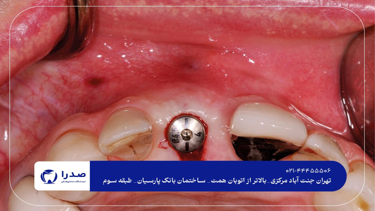 ایمپلنت دندان در تهران ایمپلنت دندان در تهران