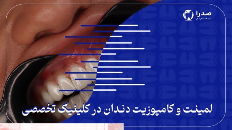 لمینیت و کامپوزیت دندان در کلینیک تخصصی