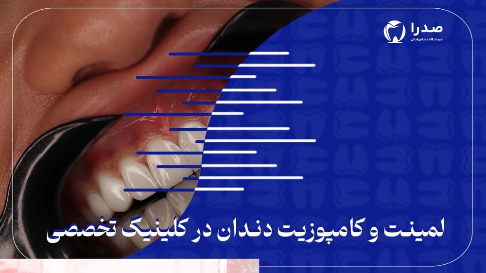 لمینیت و کامپوزیت دندان در کلینیک تخصصی لمینیت و کامپوزیت دندان در کلینیک تخصصی