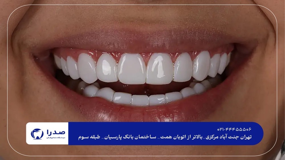 لمینیت و کامپوزیت دندان در کلینیک تخصصی لمینیت و کامپوزیت دندان در کلینیک تخصصی