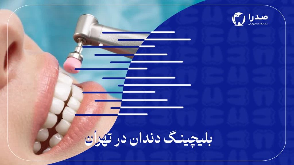 بلیچینگ دندان در تهران