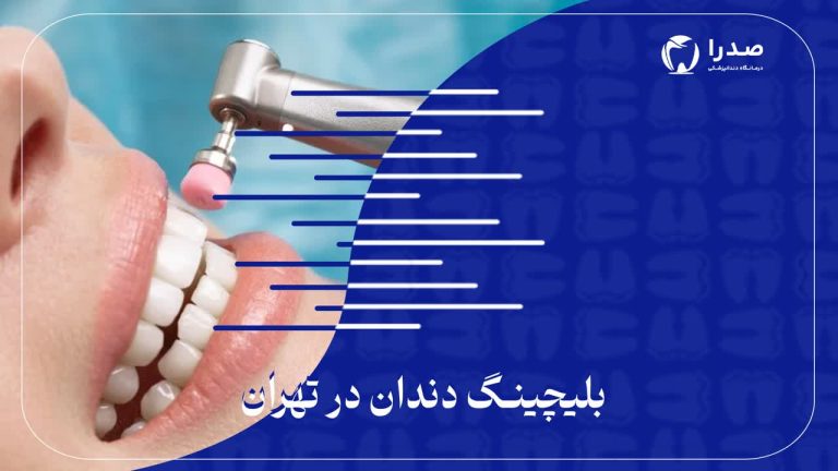 بلیچینگ دندان در تهران