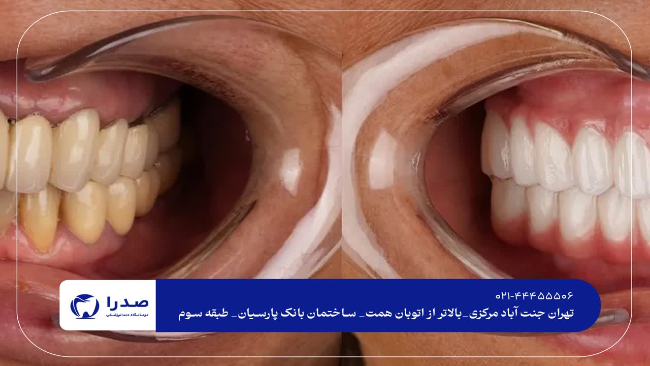 بلیچینگ دندان در تهران بلیچینگ دندان در تهران