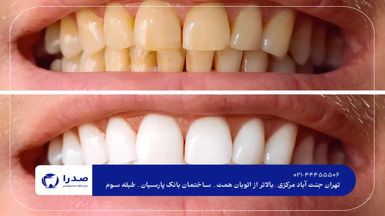 بلیچینگ دندان در تهران بلیچینگ دندان در تهران