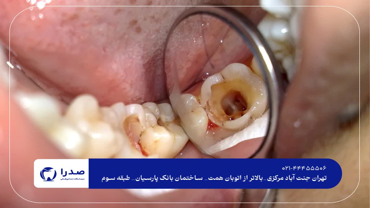 درمان پوسیدگی دندان درمان پوسیدگی دندان