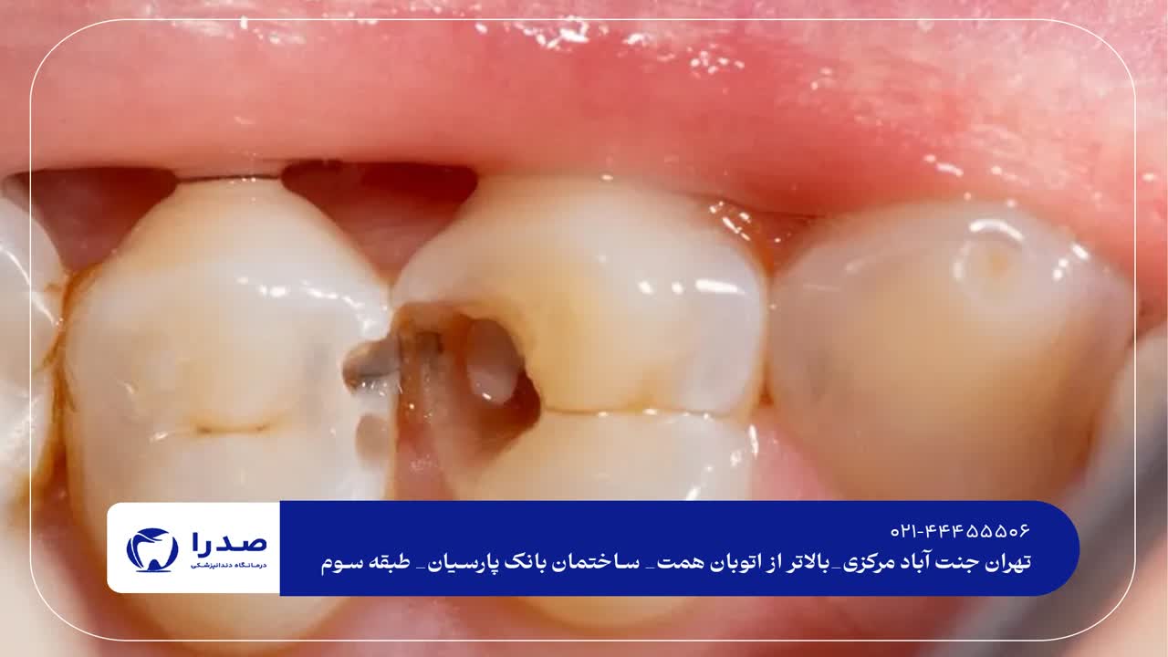 درمان پوسیدگی دندان درمان پوسیدگی دندان