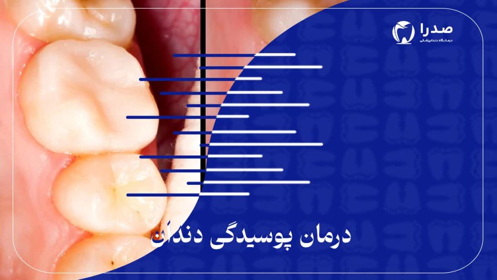 درمان پوسیدگی دندان
