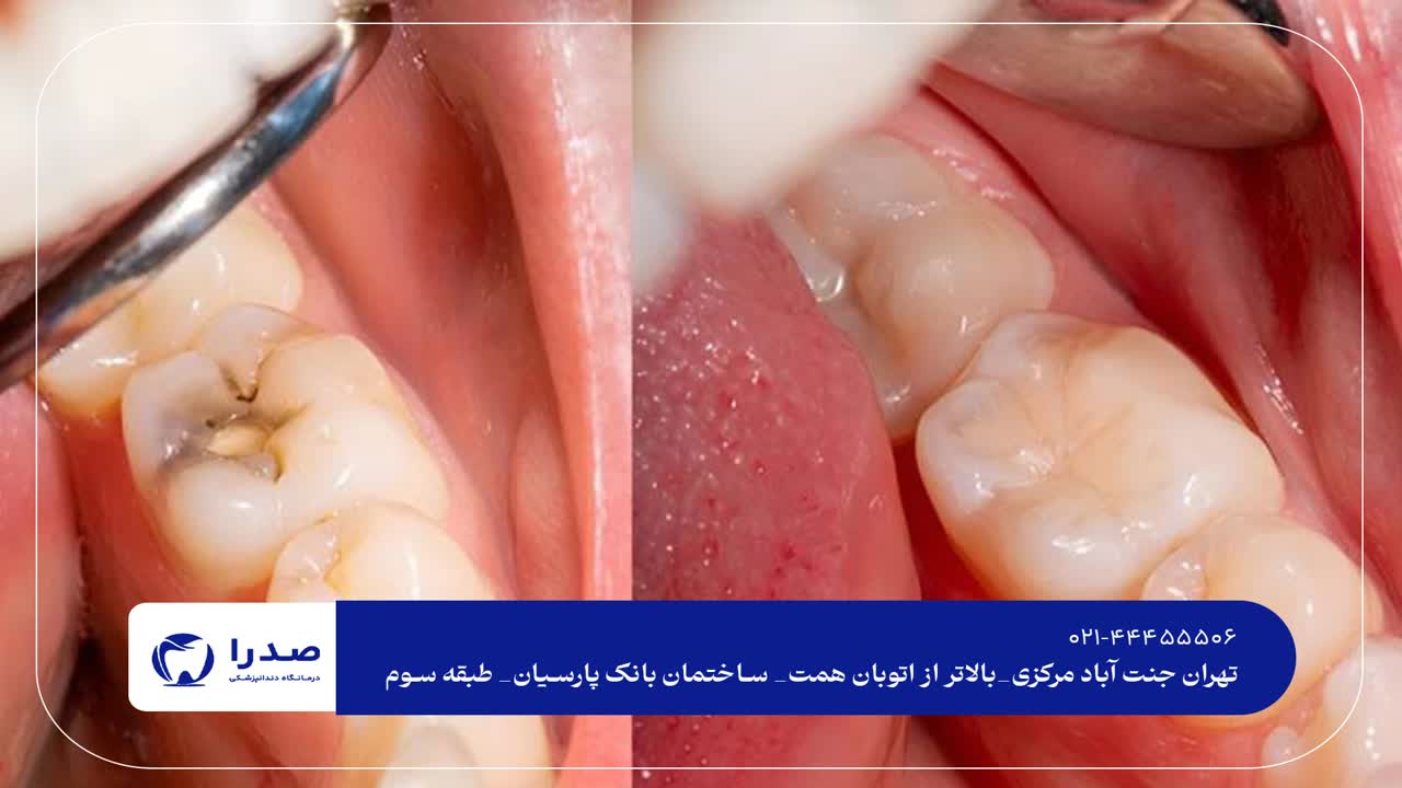 درمان پوسیدگی دندان درمان پوسیدگی دندان