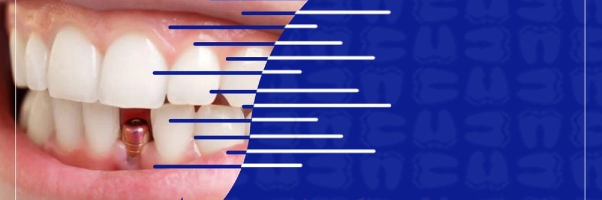 دندانپزشکی تخصصی ایمپلنت