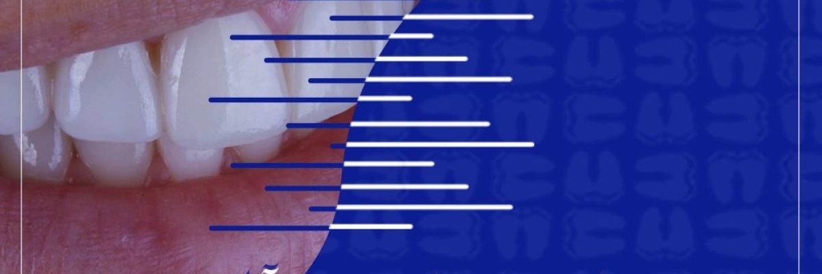 لمینت دندان در جنت‌آباد