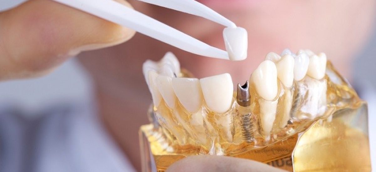 ایمپلنت-کره-ای-مزایا-و-مراحل-کاشت-بهترین-نوع-ایمپلنت-دندان